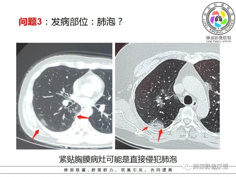 【PPT】如何快速掌握新冠肺炎(NCP)的影像识别? 【PPT】如何快速掌握新冠肺炎(NCP)的影像识别?