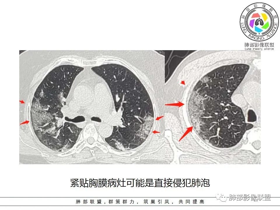 【PPT】如何快速掌握新冠肺炎(NCP)的影像识别? 【PPT】如何快速掌握新冠肺炎(NCP)的影像识别?
