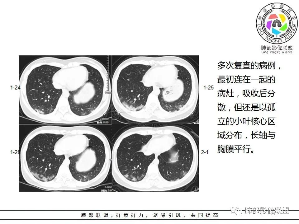 【PPT】如何快速掌握新冠肺炎(NCP)的影像识别? 【PPT】如何快速掌握新冠肺炎(NCP)的影像识别?