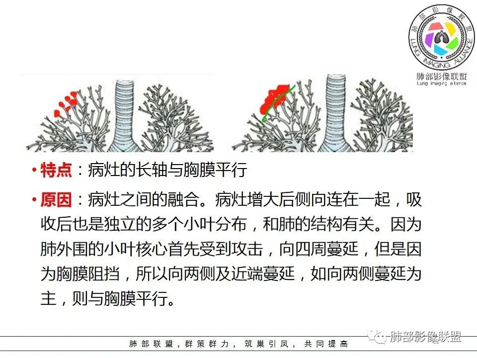【PPT】如何快速掌握新冠肺炎(NCP)的影像识别? 【PPT】如何快速掌握新冠肺炎(NCP)的影像识别?