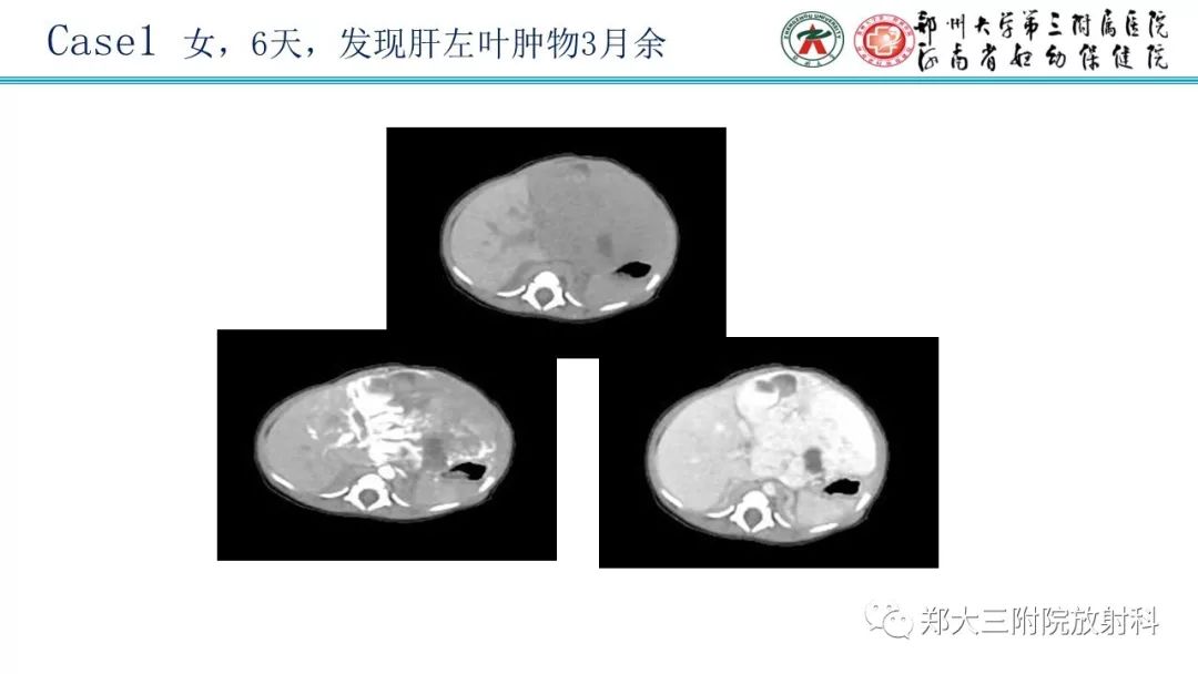 【PPT】婴儿型肝脏血管内皮瘤的影像