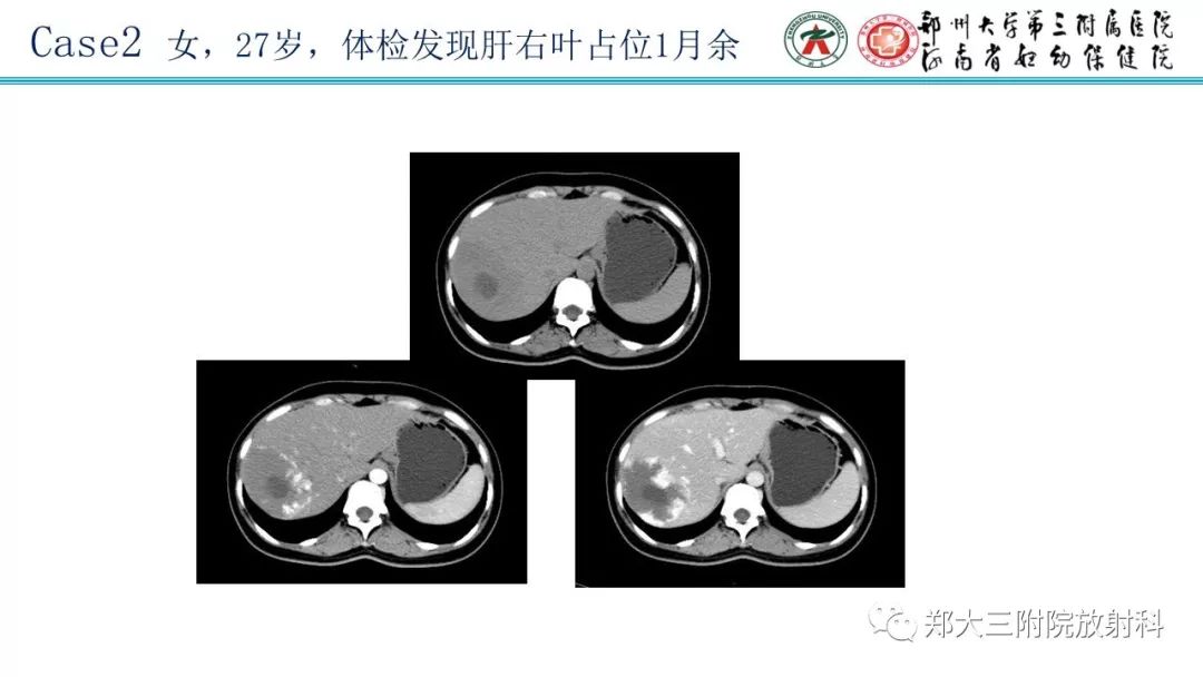 【PPT】婴儿型肝脏血管内皮瘤的影像