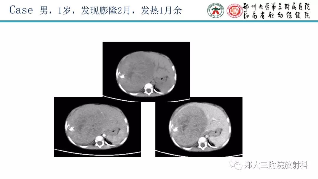 【PPT】婴儿型肝脏血管内皮瘤的影像