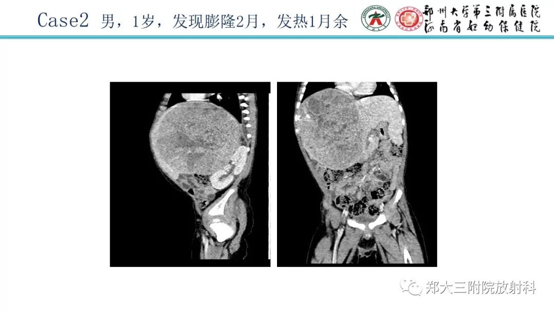 【PPT】婴儿型肝脏血管内皮瘤的影像