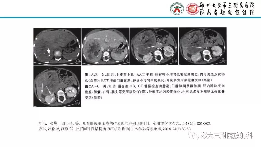 【PPT】婴儿型肝脏血管内皮瘤的影像