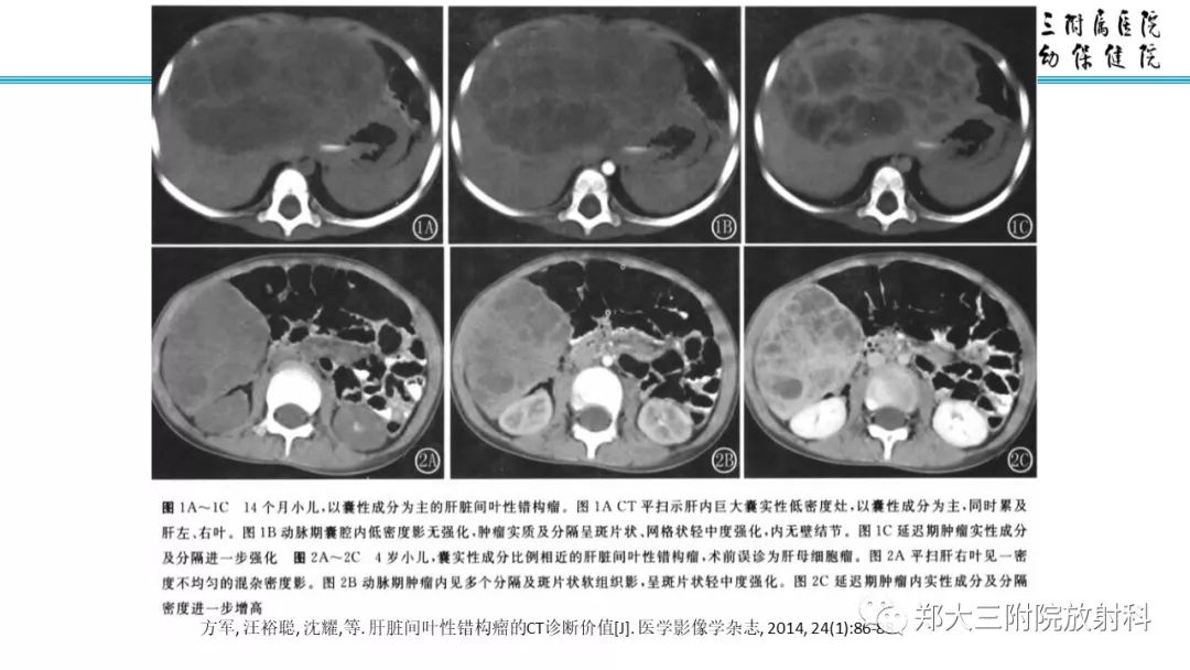 【PPT】婴儿型肝脏血管内皮瘤的影像