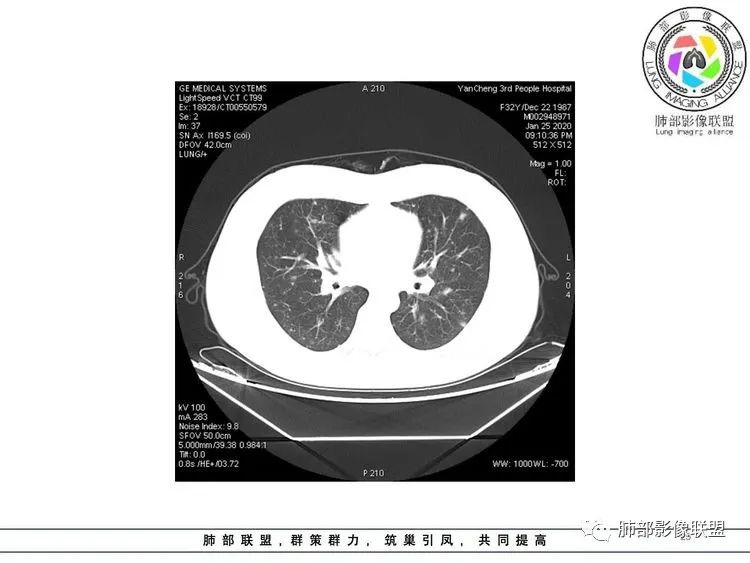 【病例】武汉归来，发热伴肺部阴影—水痘病毒性肺炎1例CT影像讨论