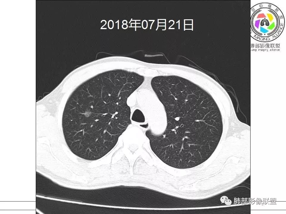 【病例】警惕结核背景下的腺癌 【病例】警惕结核背景下的腺癌