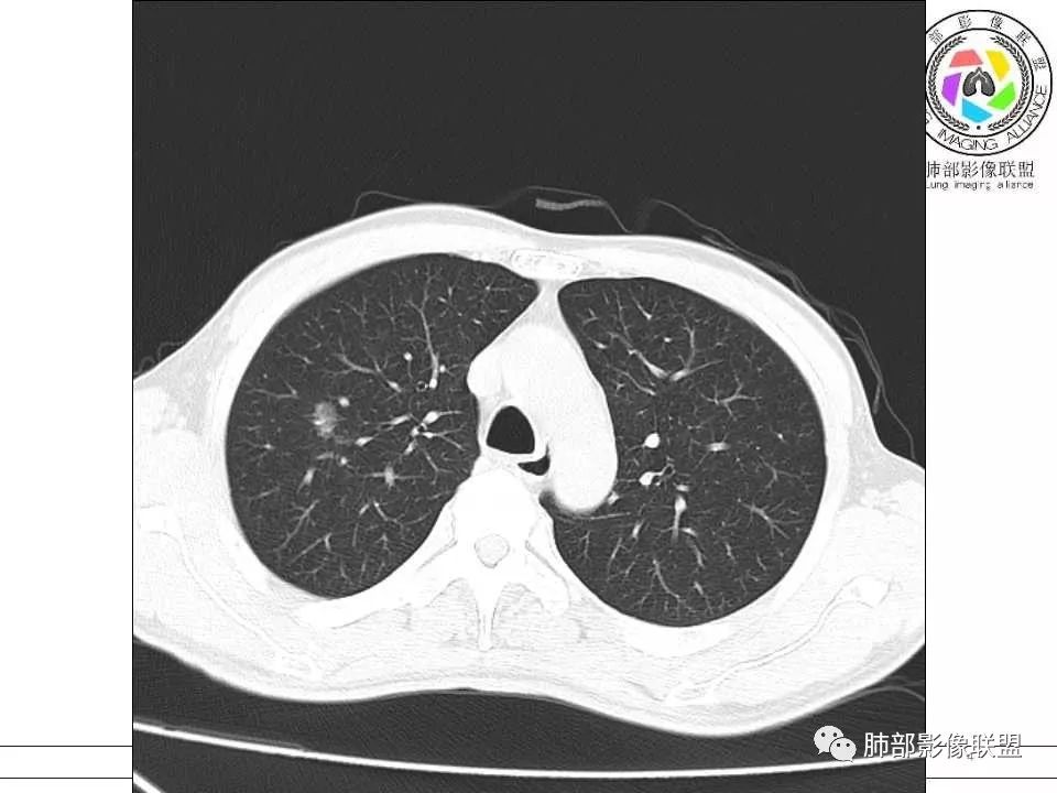【病例】警惕结核背景下的腺癌 【病例】警惕结核背景下的腺癌