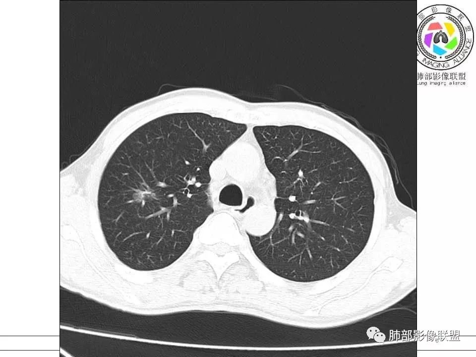 【病例】警惕结核背景下的腺癌 【病例】警惕结核背景下的腺癌