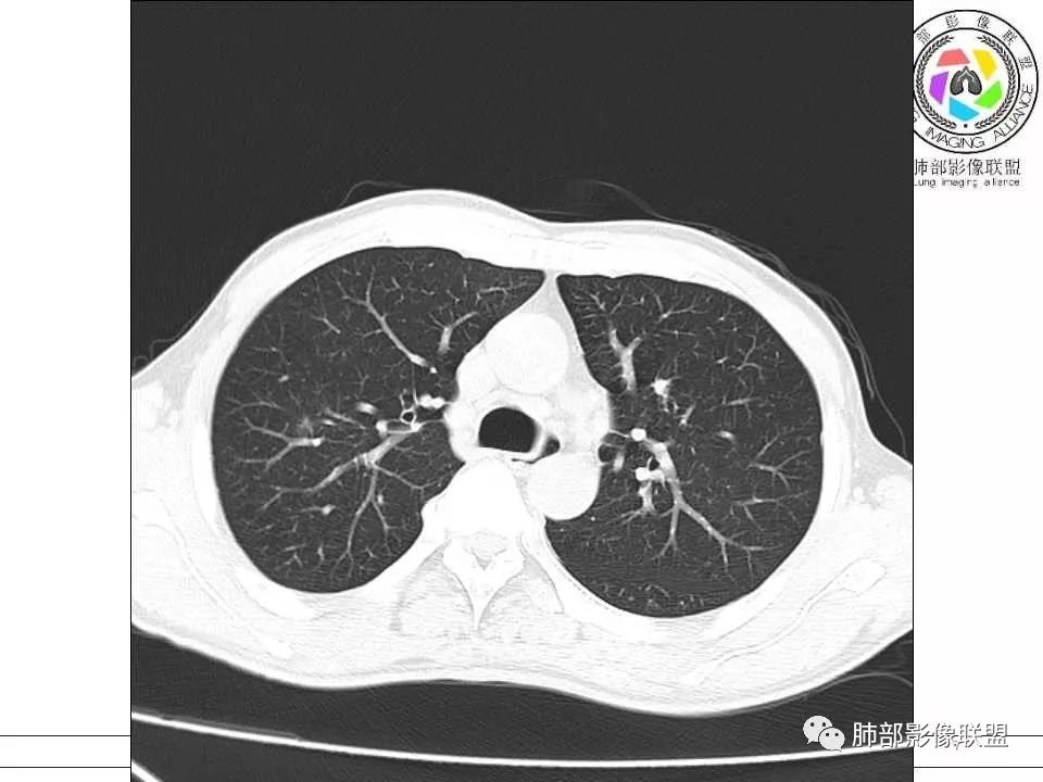 【病例】警惕结核背景下的腺癌 【病例】警惕结核背景下的腺癌