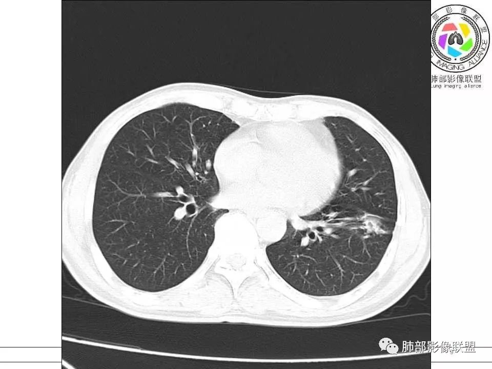 【病例】警惕结核背景下的腺癌 【病例】警惕结核背景下的腺癌