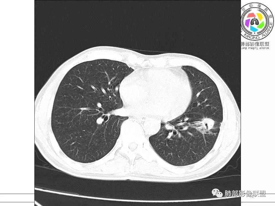 【病例】警惕结核背景下的腺癌 【病例】警惕结核背景下的腺癌