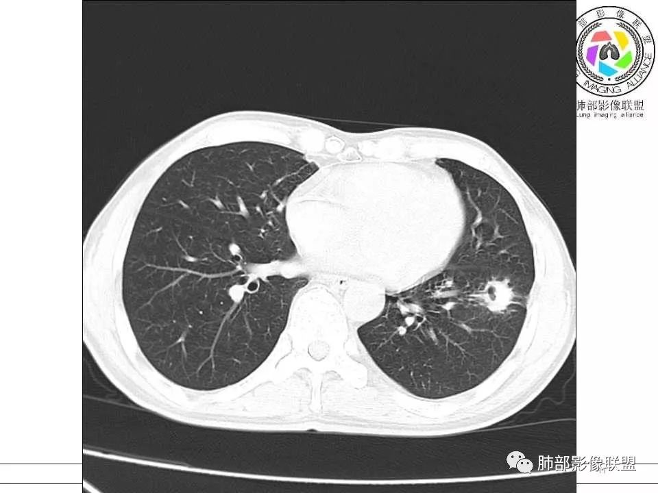 【病例】警惕结核背景下的腺癌 【病例】警惕结核背景下的腺癌