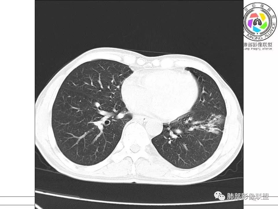【病例】警惕结核背景下的腺癌 【病例】警惕结核背景下的腺癌