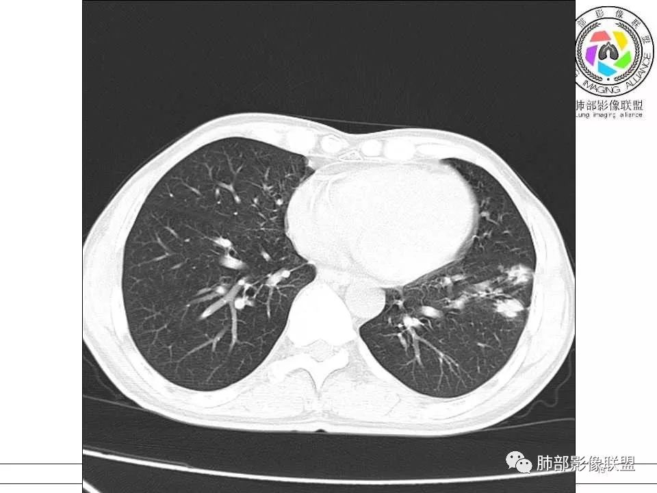 【病例】警惕结核背景下的腺癌 【病例】警惕结核背景下的腺癌