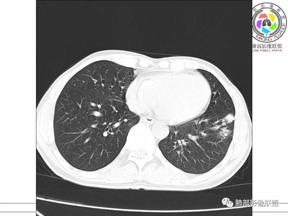 【病例】警惕结核背景下的腺癌 【病例】警惕结核背景下的腺癌