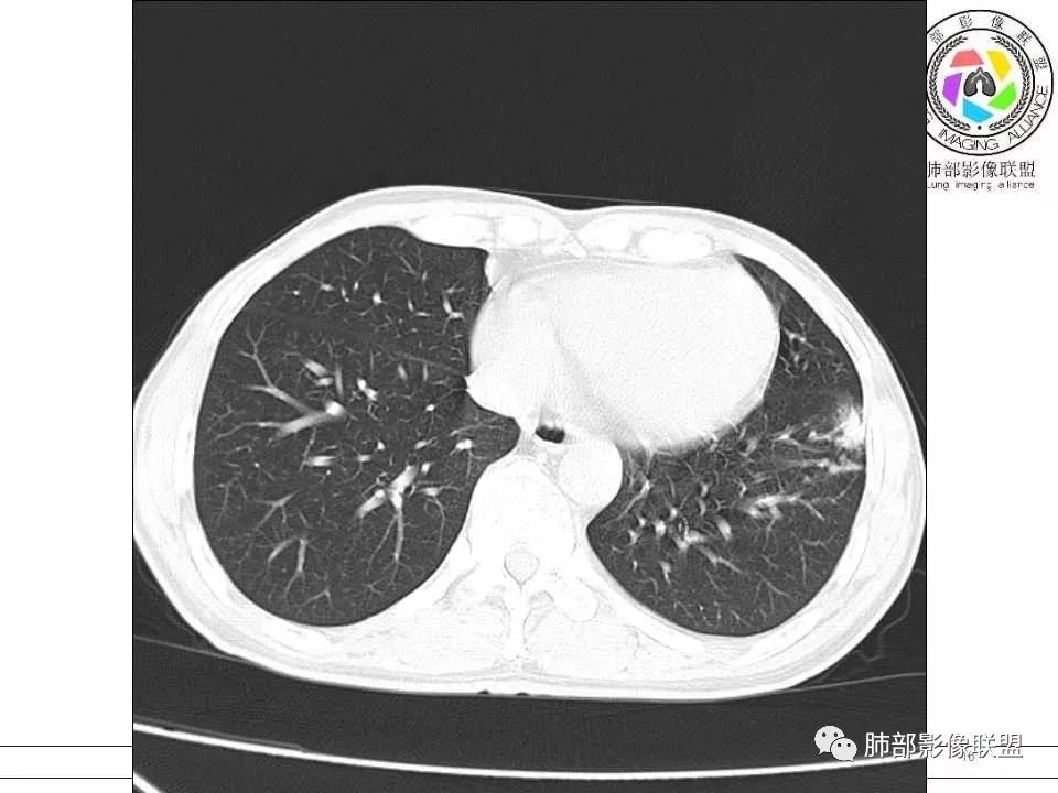 【病例】警惕结核背景下的腺癌 【病例】警惕结核背景下的腺癌