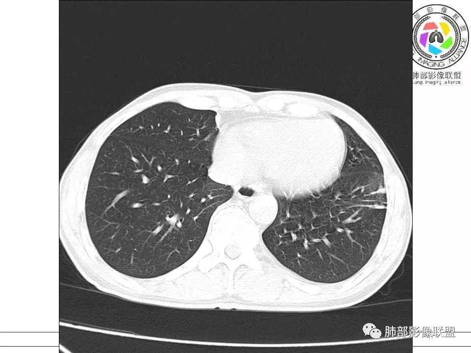 【病例】警惕结核背景下的腺癌 【病例】警惕结核背景下的腺癌