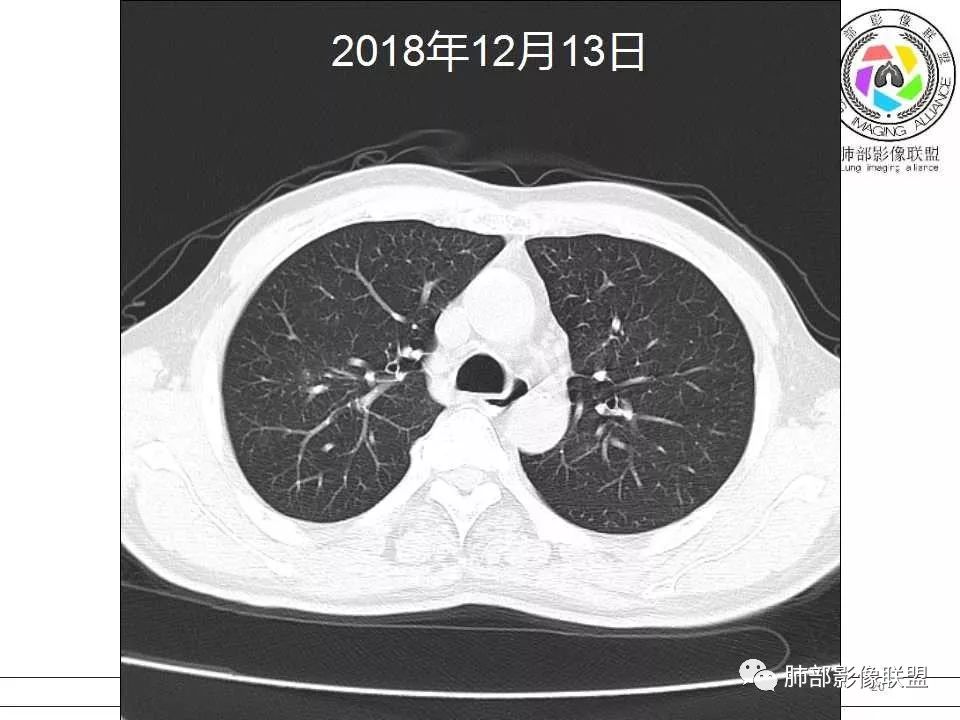 【病例】警惕结核背景下的腺癌 【病例】警惕结核背景下的腺癌