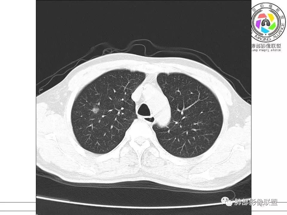 【病例】警惕结核背景下的腺癌 【病例】警惕结核背景下的腺癌