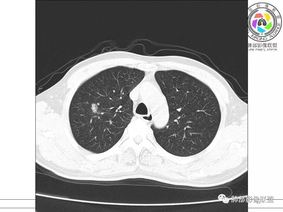 【病例】警惕结核背景下的腺癌 【病例】警惕结核背景下的腺癌