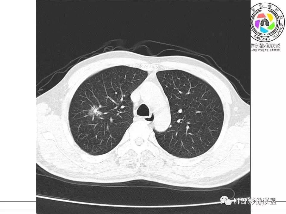 【病例】警惕结核背景下的腺癌 【病例】警惕结核背景下的腺癌