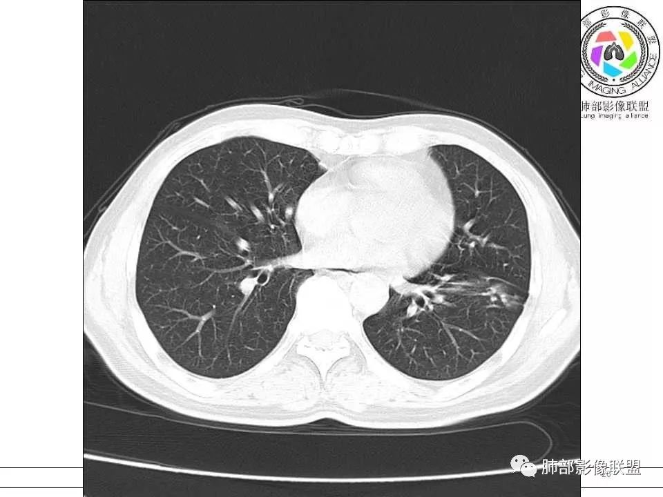 【病例】警惕结核背景下的腺癌 【病例】警惕结核背景下的腺癌