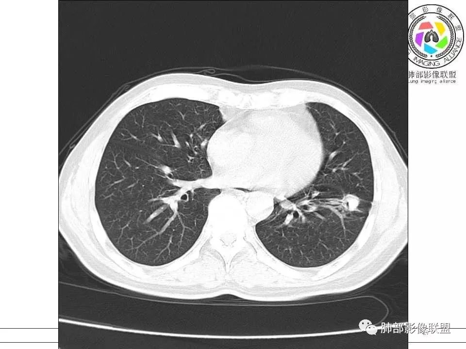 【病例】警惕结核背景下的腺癌 【病例】警惕结核背景下的腺癌