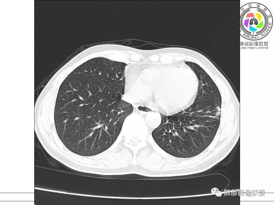 【病例】警惕结核背景下的腺癌 【病例】警惕结核背景下的腺癌