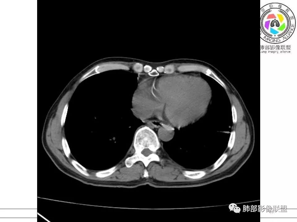 【病例】警惕结核背景下的腺癌 【病例】警惕结核背景下的腺癌