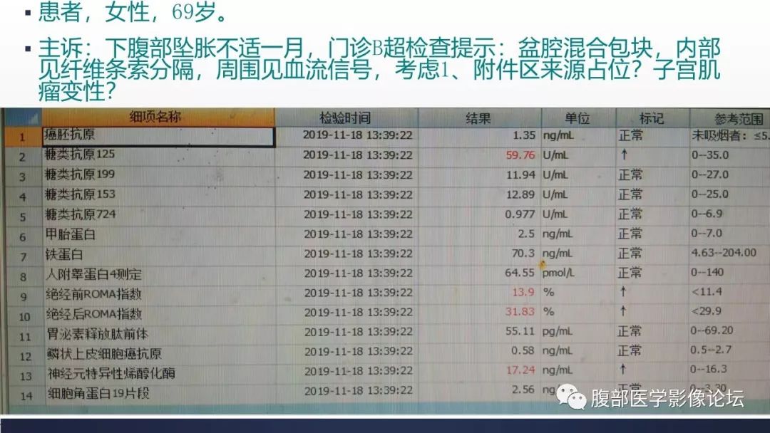 【病例】卵巢癌肉瘤1例MR影像