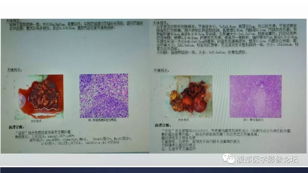 【病例】卵巢癌肉瘤1例MR影像