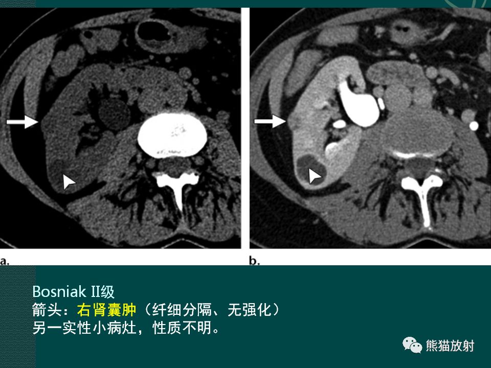 【PPT】肾脏囊性病变的CT及MRI表现