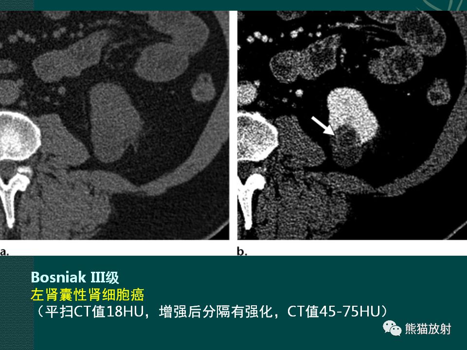 【PPT】肾脏囊性病变的CT及MRI表现