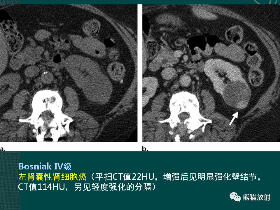 【PPT】肾脏囊性病变的CT及MRI表现
