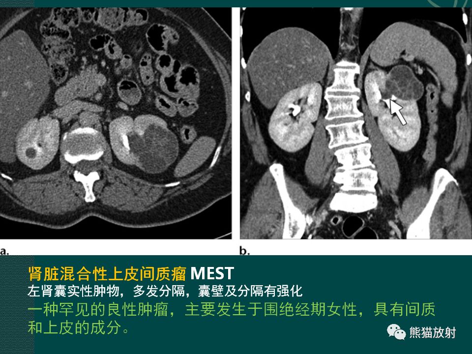 【PPT】肾脏囊性病变的CT及MRI表现