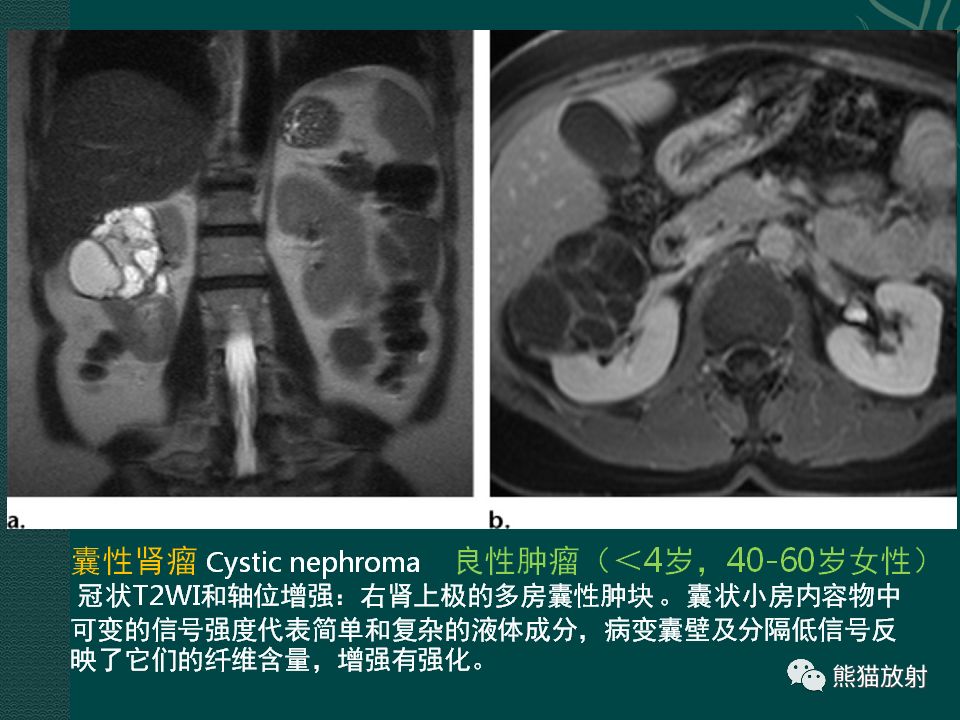 【PPT】肾脏囊性病变的CT及MRI表现