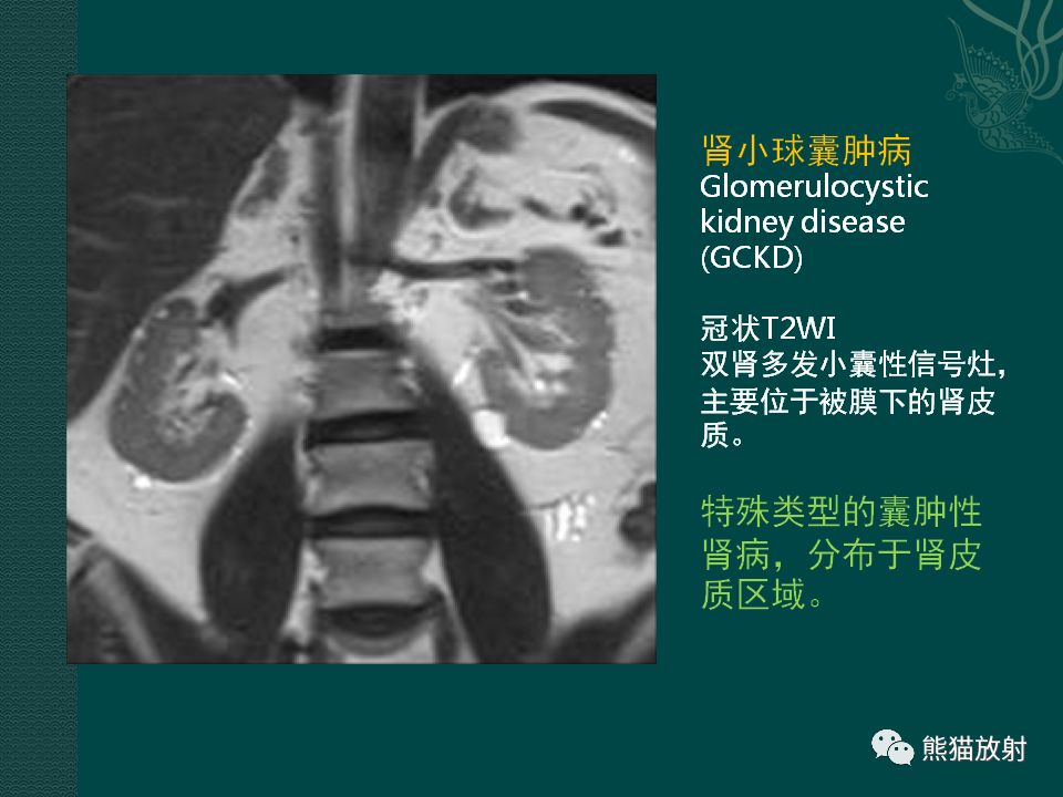 【PPT】肾脏囊性病变的CT及MRI表现