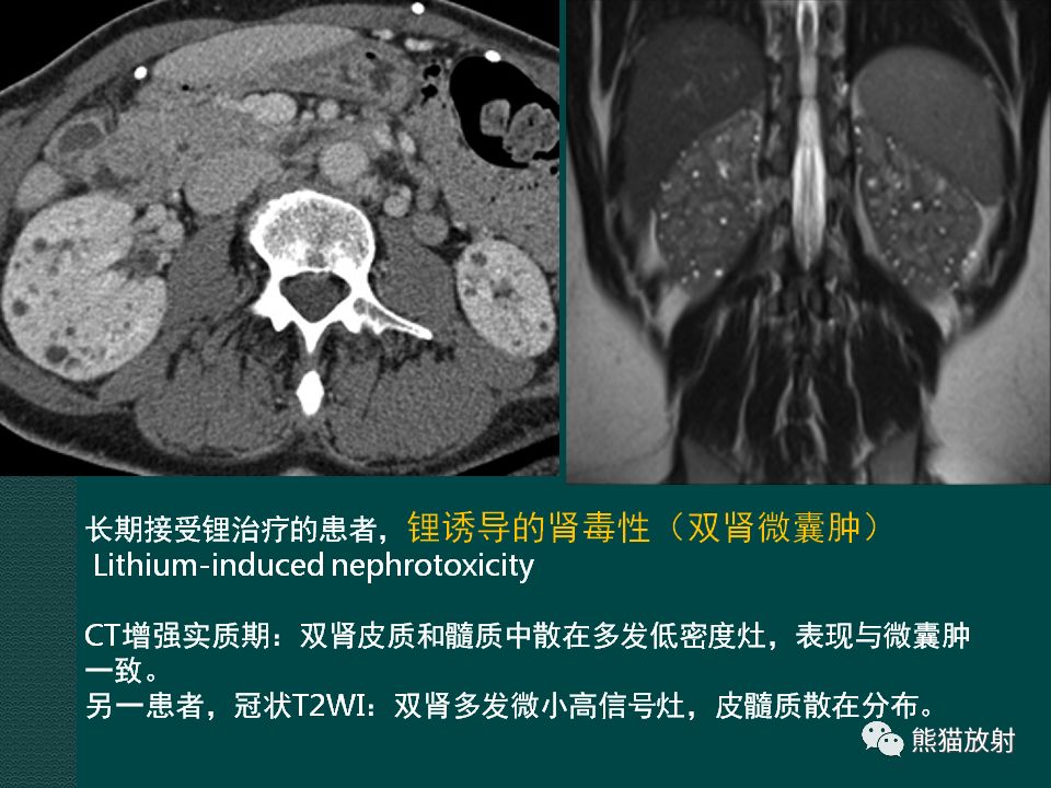 【PPT】肾脏囊性病变的CT及MRI表现