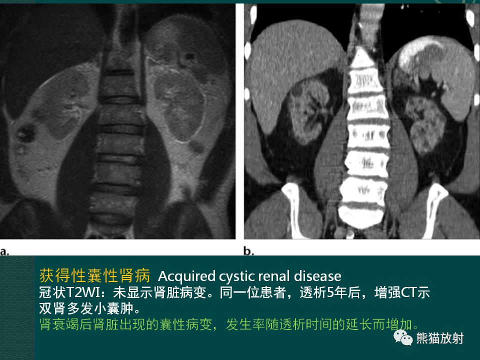 【PPT】肾脏囊性病变的CT及MRI表现