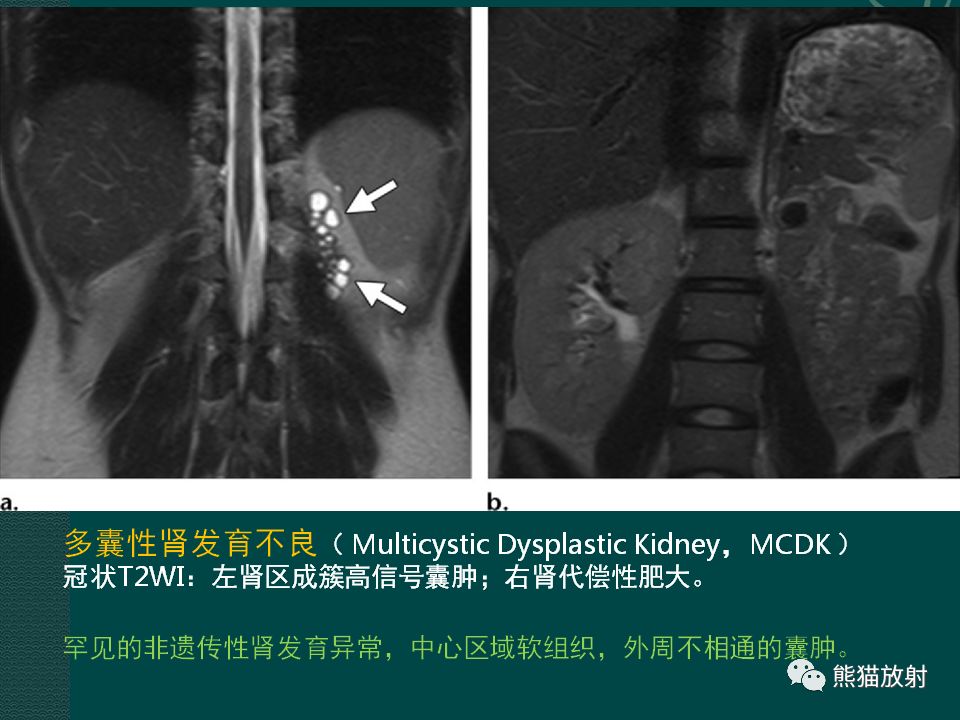 【PPT】肾脏囊性病变的CT及MRI表现