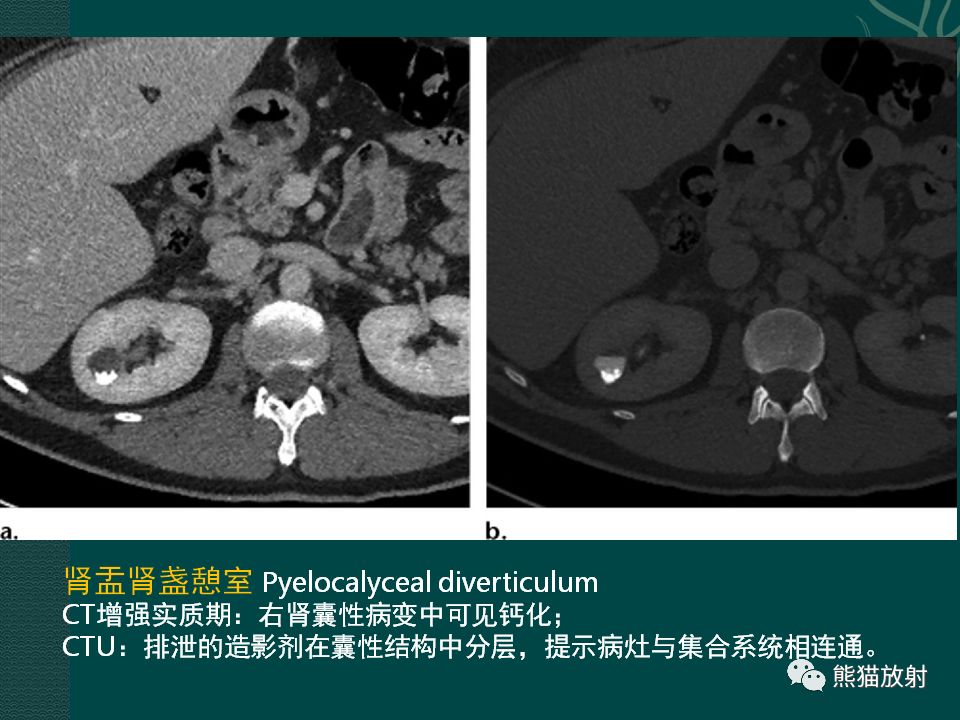 【PPT】肾脏囊性病变的CT及MRI表现