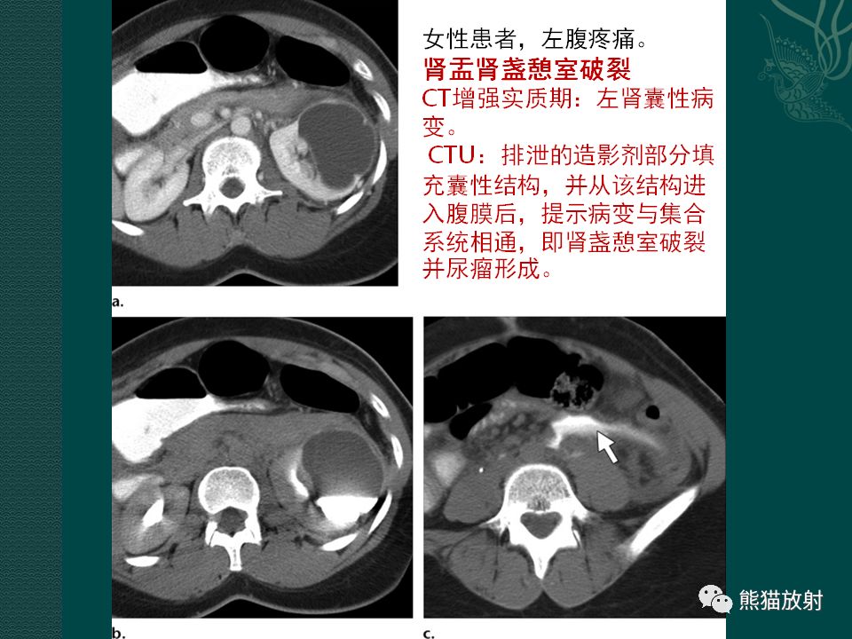 【PPT】肾脏囊性病变的CT及MRI表现