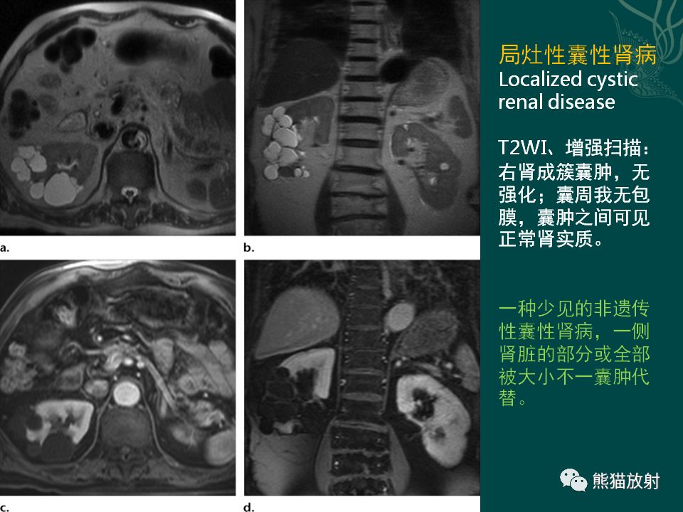【PPT】肾脏囊性病变的CT及MRI表现