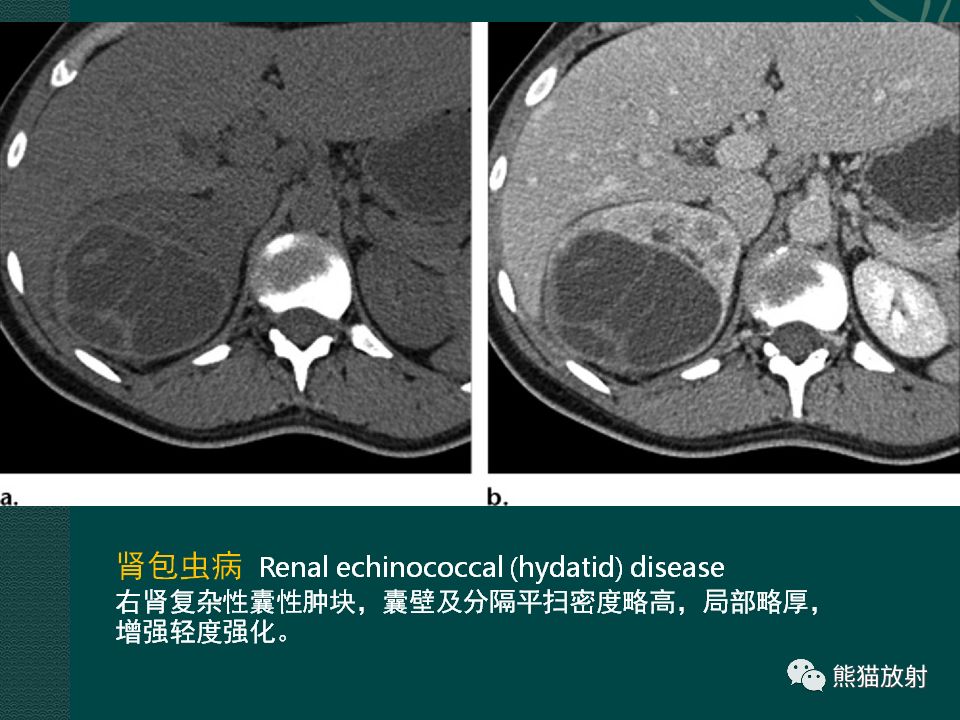 【PPT】肾脏囊性病变的CT及MRI表现