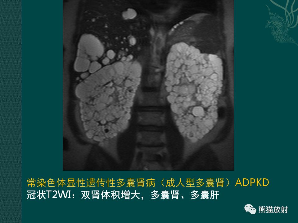 【PPT】肾脏囊性病变的CT及MRI表现
