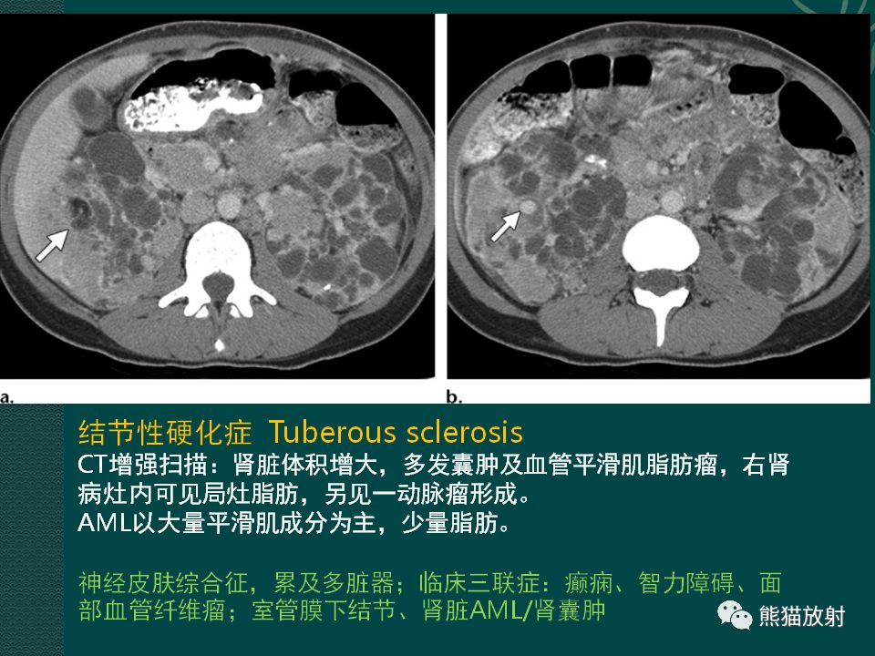 【PPT】肾脏囊性病变的CT及MRI表现
