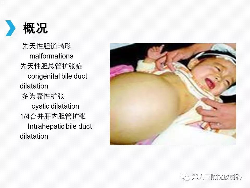 【PPT】小儿先天性胆总管囊肿CT诊断