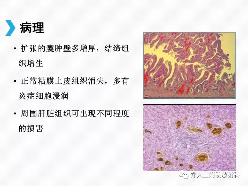 【PPT】小儿先天性胆总管囊肿CT诊断
